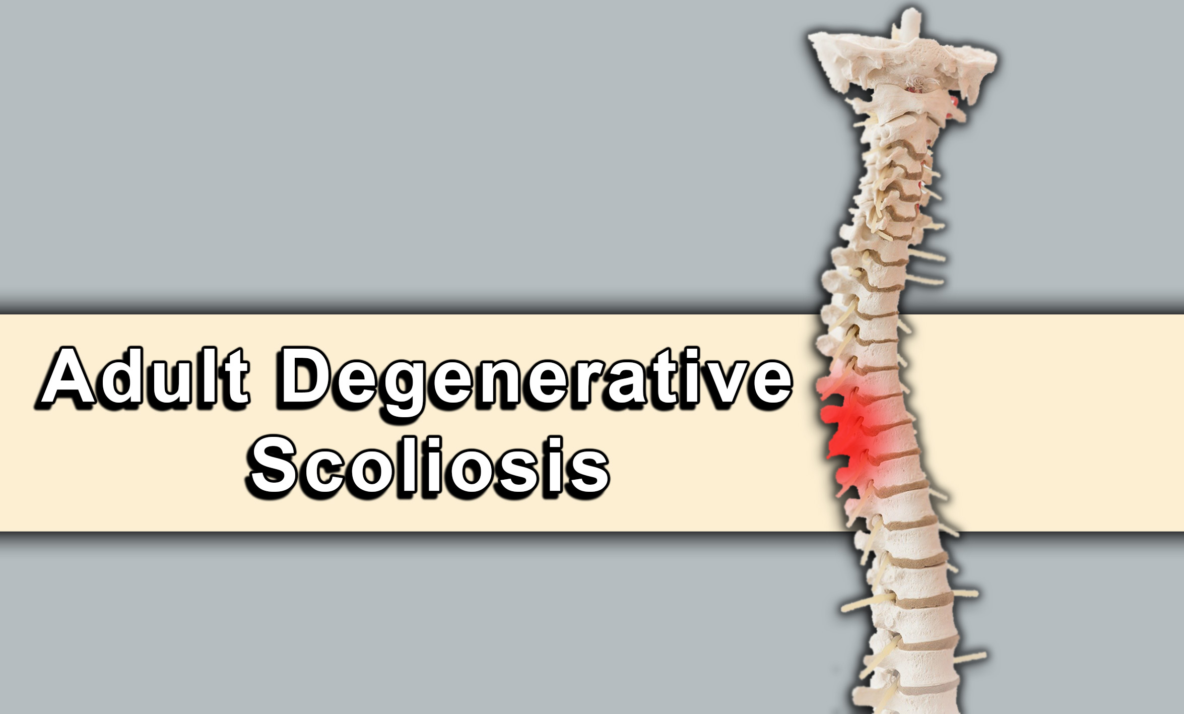 Adult degenerative scoliosis