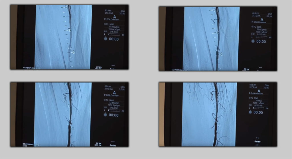 Panthera is a new technology look inside of the blood vessel while cutting the plate Images.