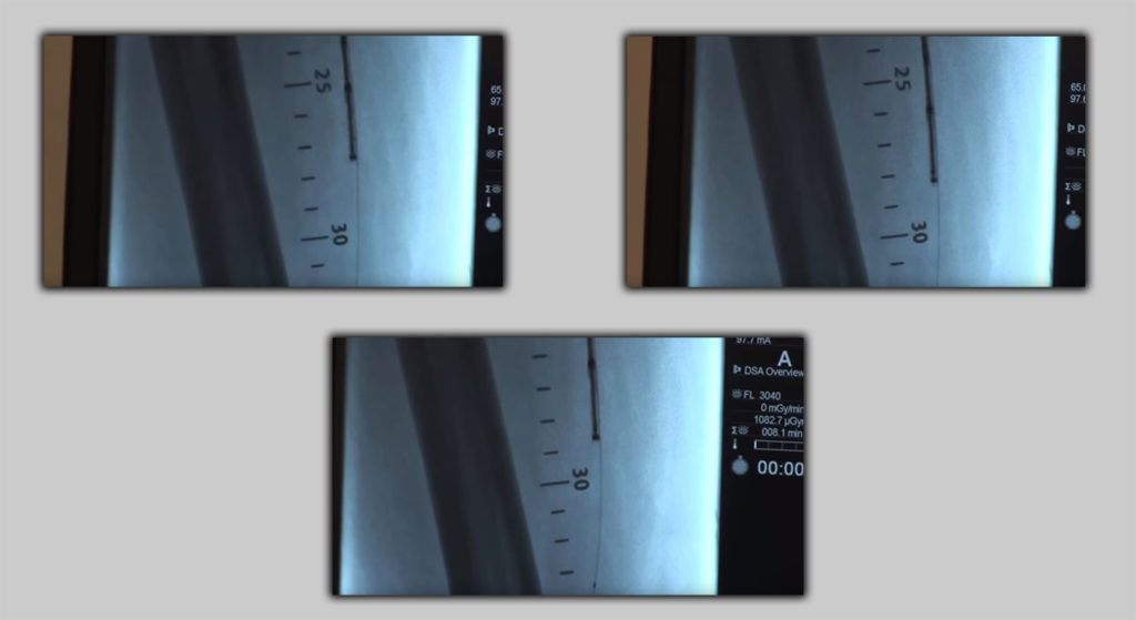 Panthera is a new technology look inside of the blood vessel while cutting the plate - Images