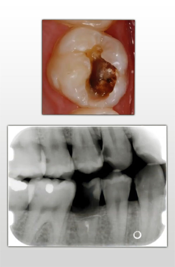 lose a tooth completely at the root canal or worse