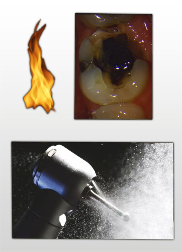 Water through the procedure to keep the area cool during tooth drilling