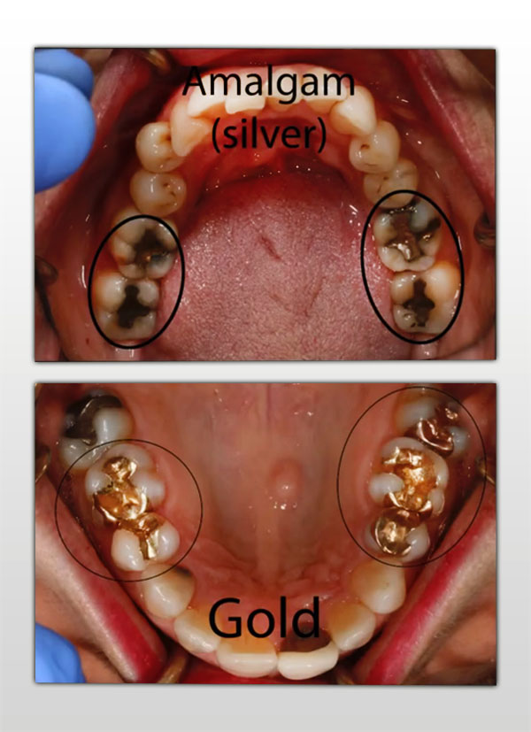 Different types of filling materials - Silver, Gold
