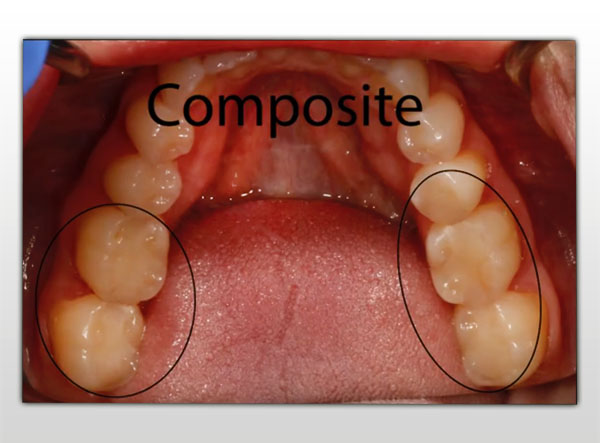 Composite
