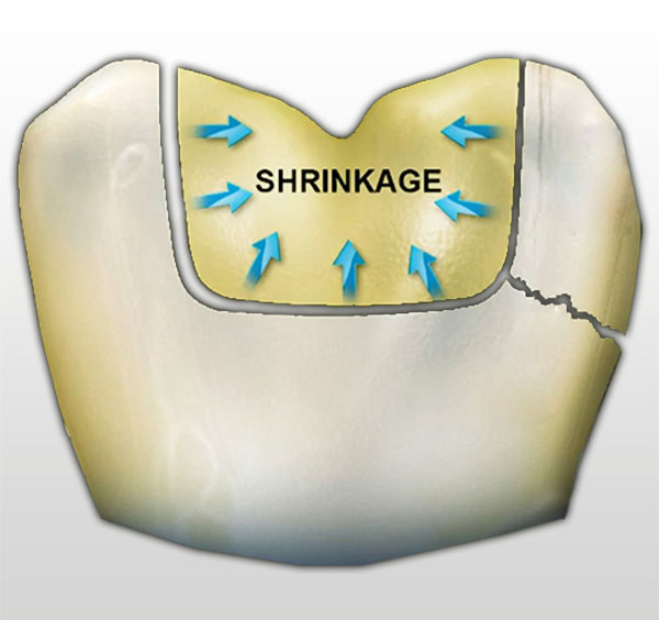 No gap between the filling and the tooth