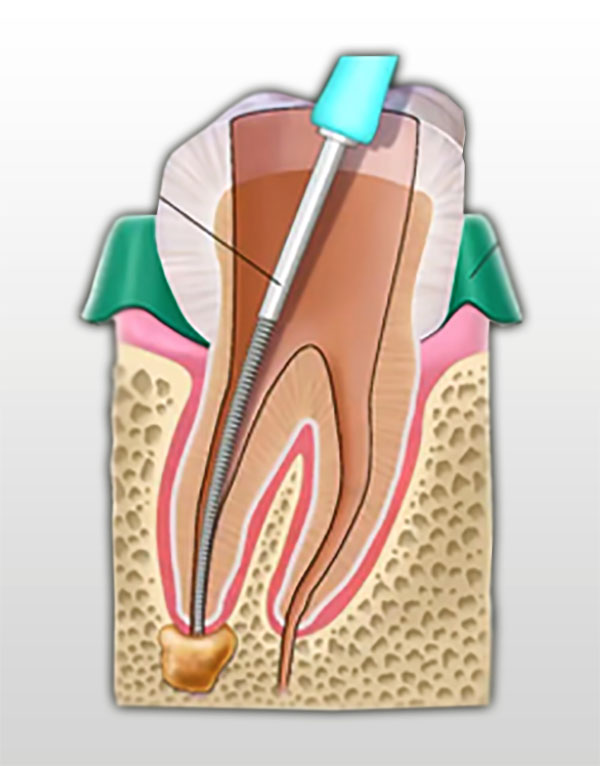A dentist goes in and removes the nerve in that tooth