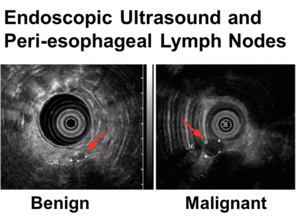 Esophageal Cancer Lymph Nodes