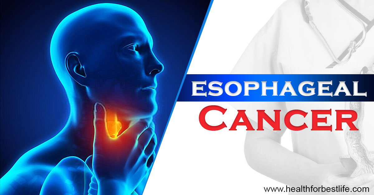 Symptoms of esophageal cancer