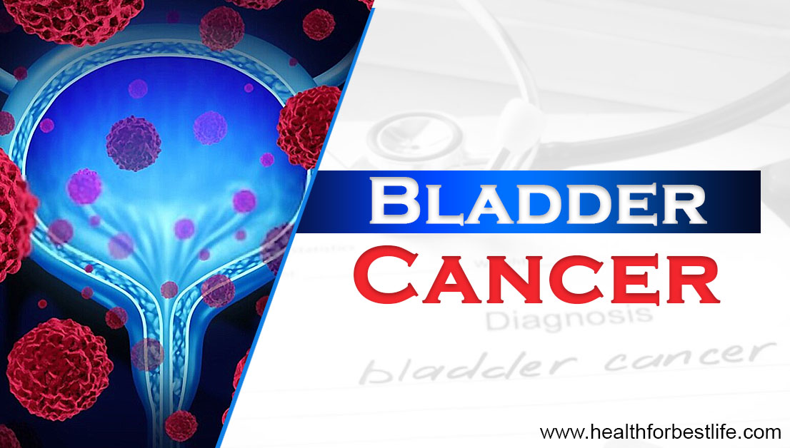 What are the symptoms of bladder cancer