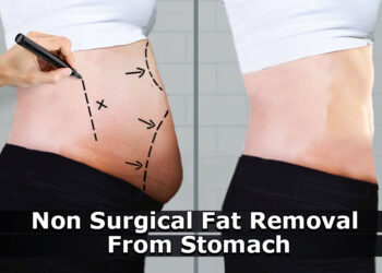 Non Surgical Fat Removal from Stomach