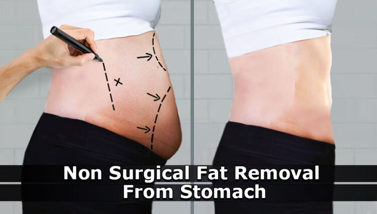 Non Surgical Fat Removal from Stomach