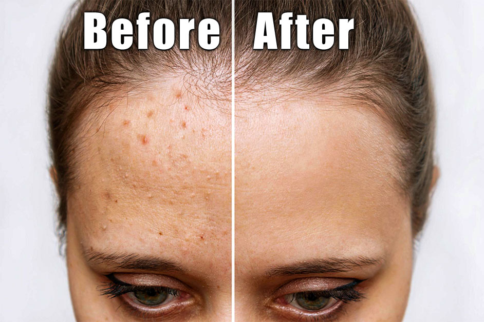 Pimples before after