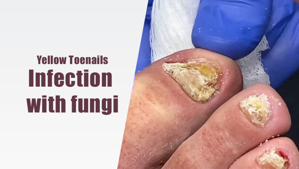 Infection with fungis