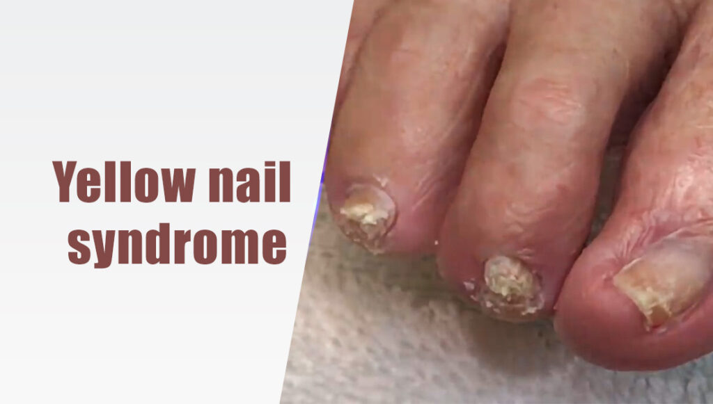 Yellow nail syndrome