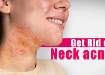 How To Get Rid Of Neck Acne