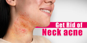 How To Get Rid Of Neck Acne