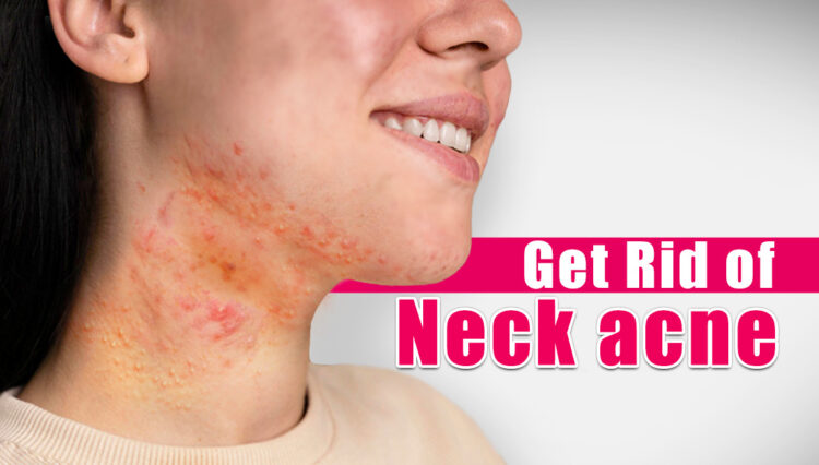 How To Get Rid Of Neck Acne