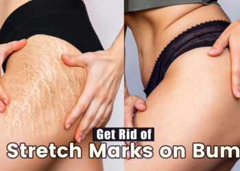 How To Get Rid Of Stretch Marks On Bum Quickly