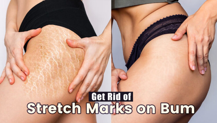 How To Get Rid Of Stretch Marks On Bum Quickly