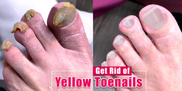How To Get Rid Of Yellow Toenails