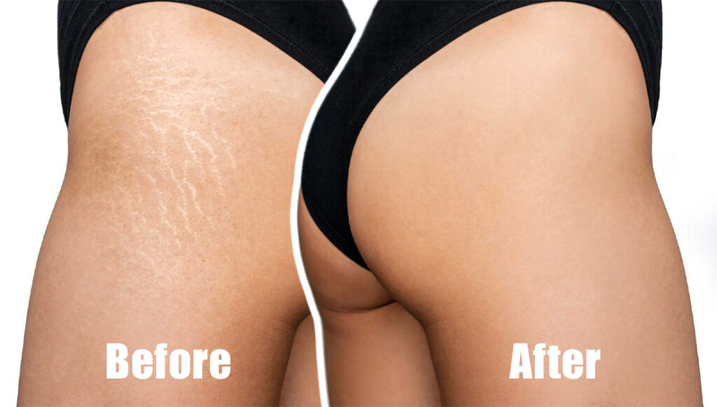 Stretch Marks 04 - Before and After