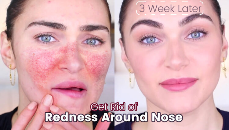 How To Get Rid Of Redness Around Nose