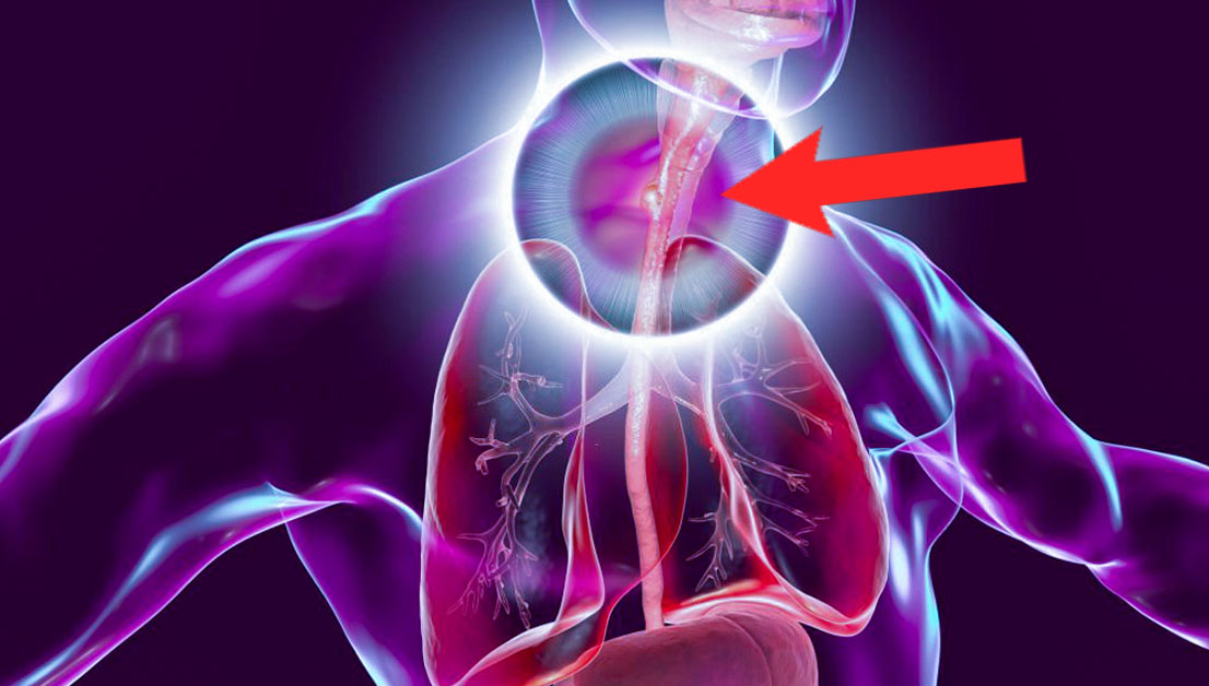 Esophageal 01