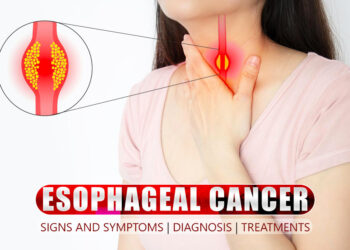 Esophageal Cancer Signs and Symptoms | Diagnosis | Treatments