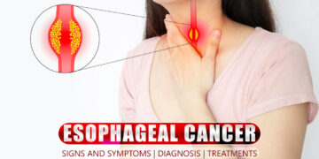 Esophageal Cancer Signs and Symptoms | Diagnosis | Treatments