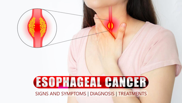 Esophageal Cancer Signs and Symptoms | Diagnosis | Treatments