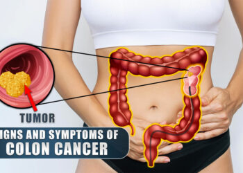 What Are The Signs And Symptoms Of Colon Cancer