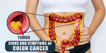 What Are The Signs And Symptoms Of Colon Cancer