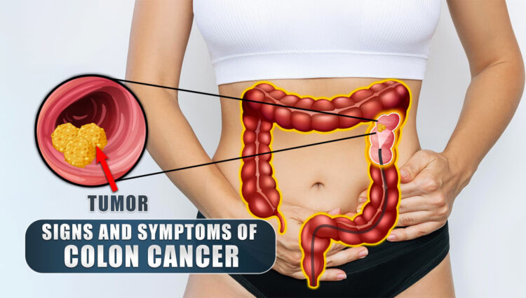 What Are The Signs And Symptoms Of Colon Cancer