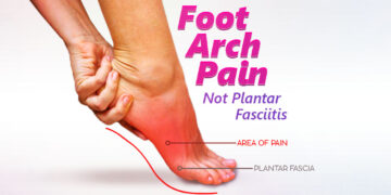 Foot Arch Pain Not Plantar Fasciitis