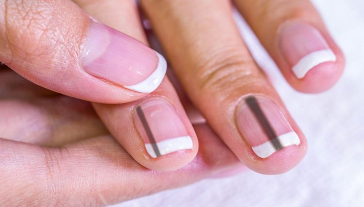 How to Get Rid of Black Lines on Nails